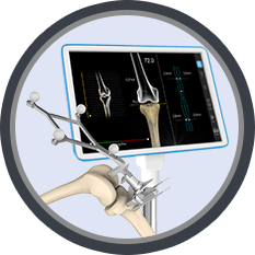 Total Knee Replacement(TKR)