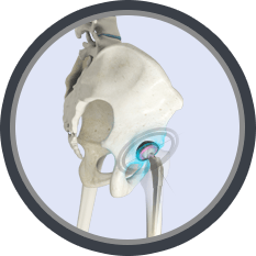 Optimized Positioning System Total Hip